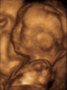 UltrasoundBaby20Weeks-223px-PublicDomain